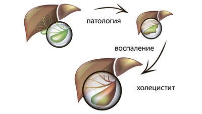 Холецистит