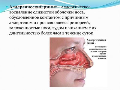 Аллергический ринит