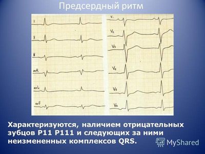 Характеристика предсердного ритма