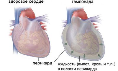 Тампонада сердца