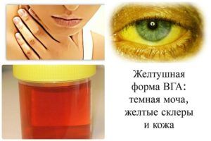 Симптоматика гепатита А