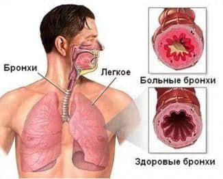 chto-proisxodit-s-bronxami-vo-vremya-vospaleniya