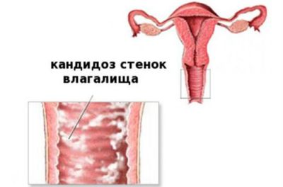 Особенности кандидозного вагинита у взрослых