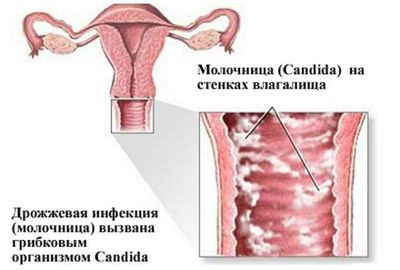 причины кольпита
