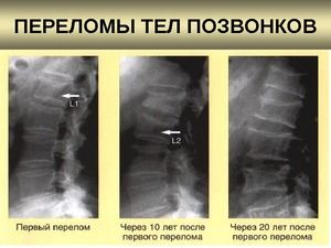 Компрессионный перелом позвоночника 1-й степени