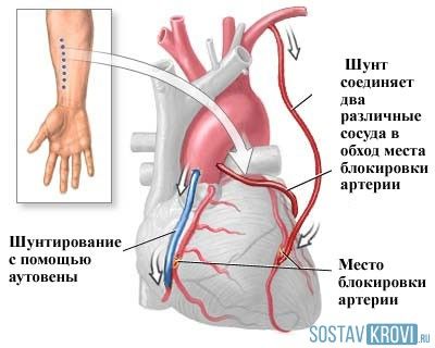 Ход операции