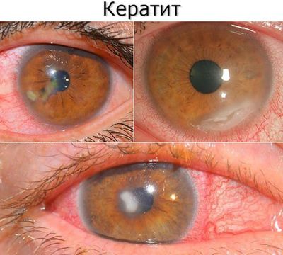 Симптомы кератита