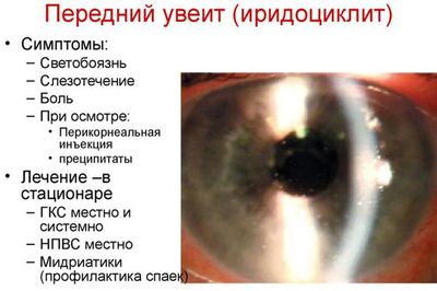 Симптомы иридоциклита