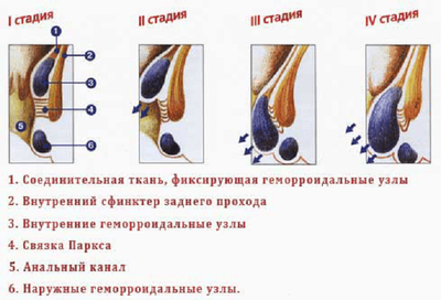 Стадии геморроя