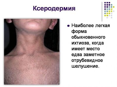 развитие ксеродермии