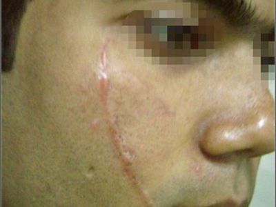 Как убрать шрамы и рубцы без операции? .