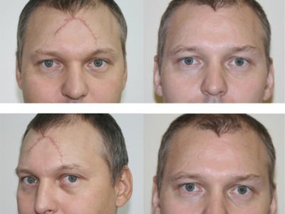 Методы избавления от рубцов