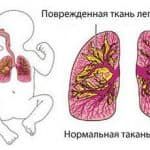 хламидия пневмония у детей