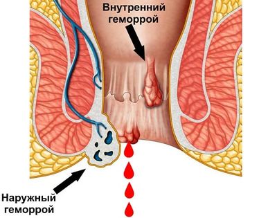 Кровотечение