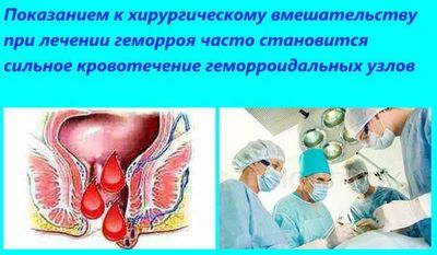 Лопнул геморрой