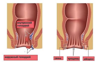 Геморрой и свищ