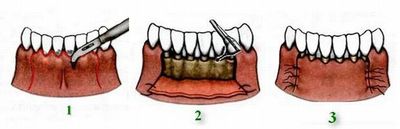 Методика лоскутной операции на деснах