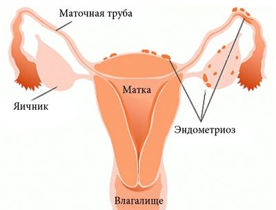 мазня вместо месячных