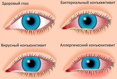 Виды конъюктивита