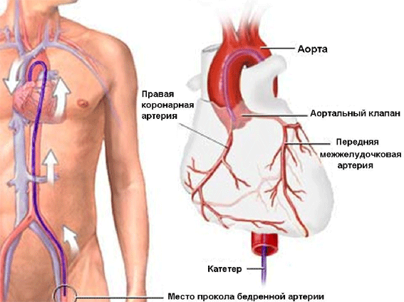 Коронарография