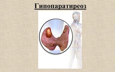 Что такое гипопаратиреоз