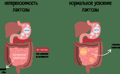 Непереносимость лактозы