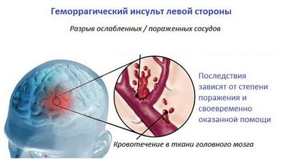 Геморрагический инсульт левой стороны