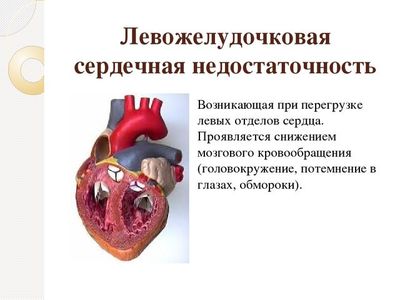 Левожелудочковая недостаточность