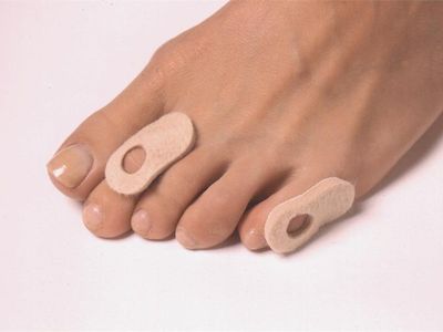 Лечение мозолей на пальцах ног.
