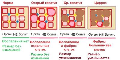 Печень при разных стадиях гепатита