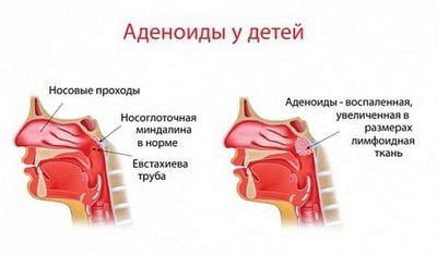 adenoidy