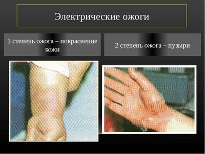 Электрические травмы