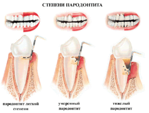 степени пародонтита