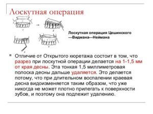 лоскутная операция
