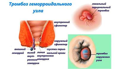 Геморрой