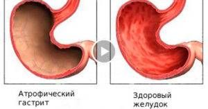 Атрофия слизистой желудка
