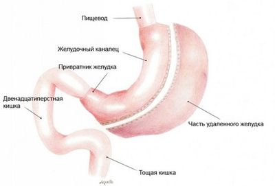 удаление желудка