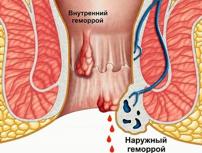 Кровоточивость