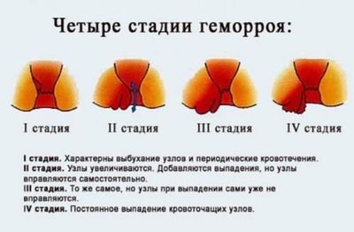 стадии геморроя