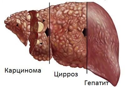 Осложнения гепатита С