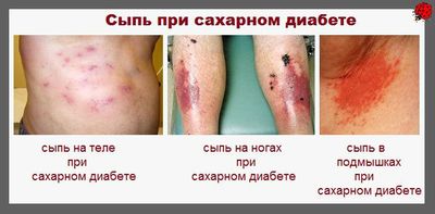 Почему повышается сахар в крови