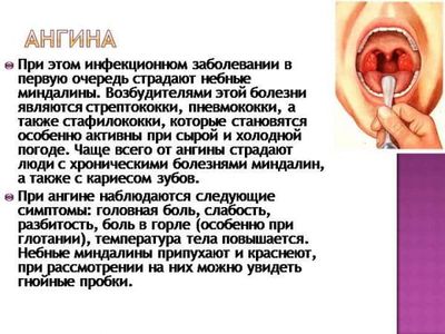 Признаки тонзиллита и подходы к его лечению