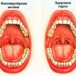 фолликулярная ангина