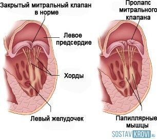 Пролапс митрального клапана (ПМК)