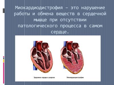 Миокардиодистрофия