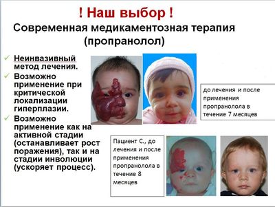 Лечение гемангиомы
