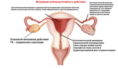 Противозачаточные при эндометриозе