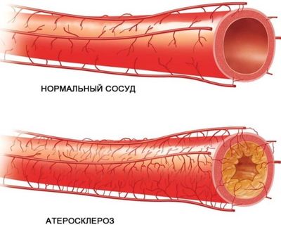 Атеросклероз сосудов