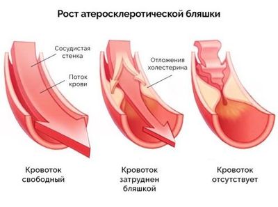 Формирование атеросклеротической бляшки