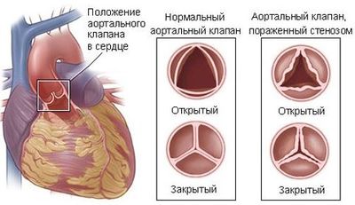 Аортальный стеноз